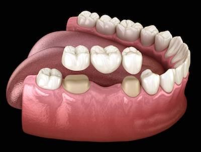 dental bridge illustration